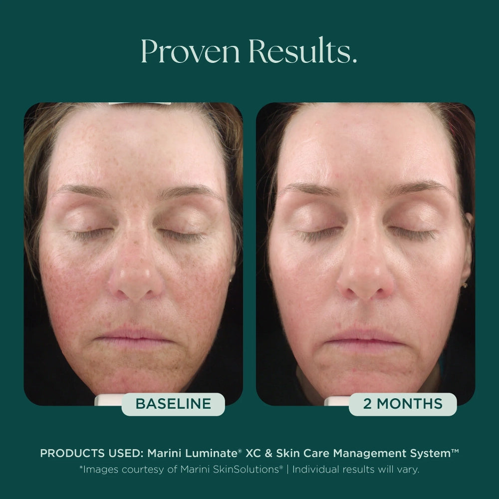 Voor en na foto Jan Marini Luminate XC Face Lotion na 2 maanden gebruik: egalere en frissere teint (individuele resultaten kunnen variëren)