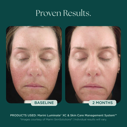 Voor en na foto Jan Marini Luminate XC Face Lotion na 2 maanden gebruik: egalere en frissere teint (individuele resultaten kunnen variëren)